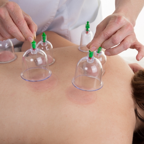 Cupping-Stonegate-Physiotherapy-and-Massage-Clinic-Airdrie-AB